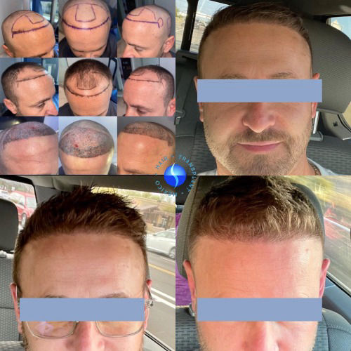 FUE hair transplant before and after results 2500 grafts Tijuana