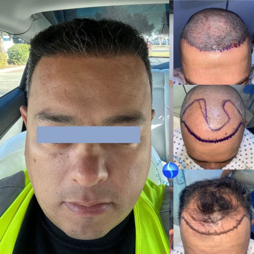 Hairline restoration results after 6 months in Mexico clinic