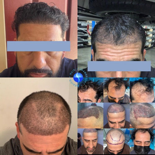 Crown hair transplant density improvement before and after